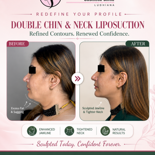 Double Chin Liposuction: Procedure, Benefits, Recovery and Results